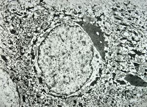F, 11y. | ichthyosis hystrix type Curth-Macklin F, 11y. | ichthyosis hystrix type Curth-Macklin